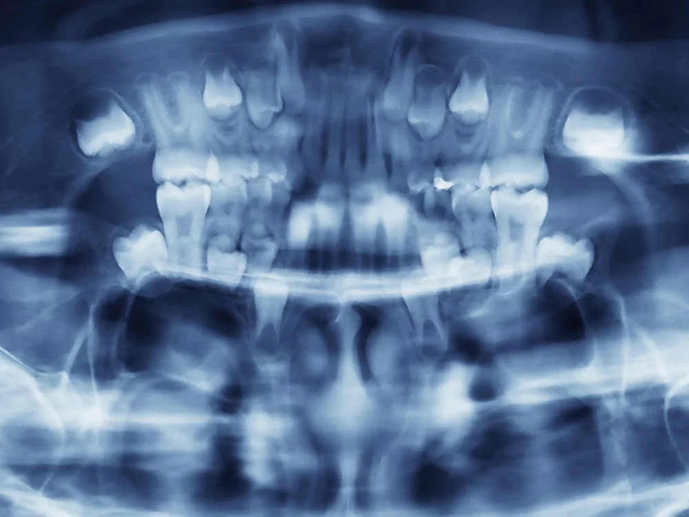 Digital X-Rays