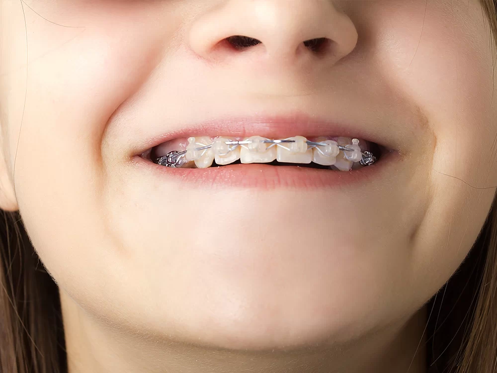 Icon® Resin Infiltration Buda, TX | Buda Kids Teeth